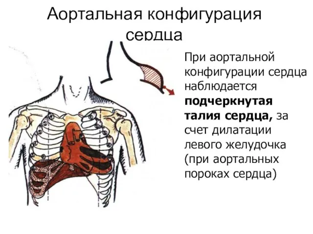 Аортальная конфигурация сердца При аортальной конфигурации сердца наблюдается подчеркнутая талия сердца, за