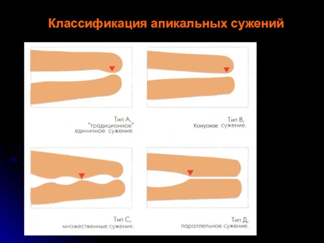 Классификация апикальных сужений