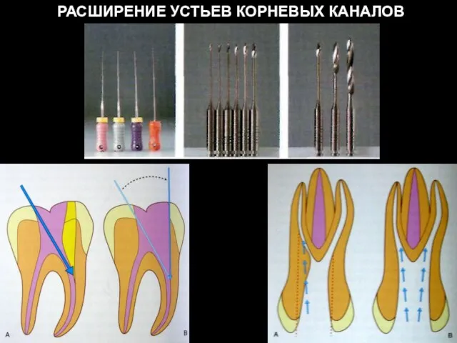 РАСШИРЕНИЕ УСТЬЕВ КОРНЕВЫХ КАНАЛОВ