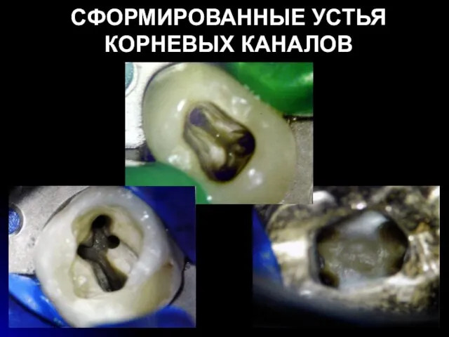 СФОРМИРОВАННЫЕ УСТЬЯ КОРНЕВЫХ КАНАЛОВ