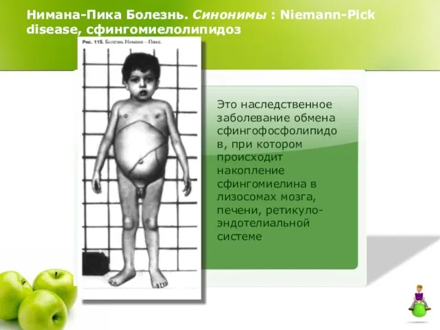 Нимана-Пика Болезнь. Синонимы : Niemann-Pick disease, сфингомиелолипидоз Это наследственное заболевание обмена сфингофосфолипидов,