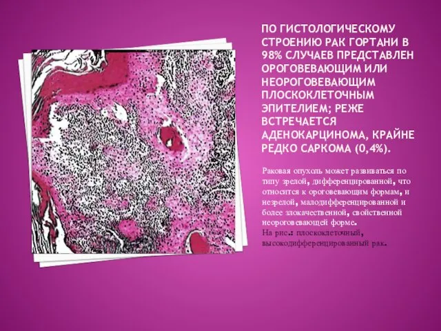 По гистологическому строению рак гортани в 98% случаев представлен ороговевающим или неороговевающим