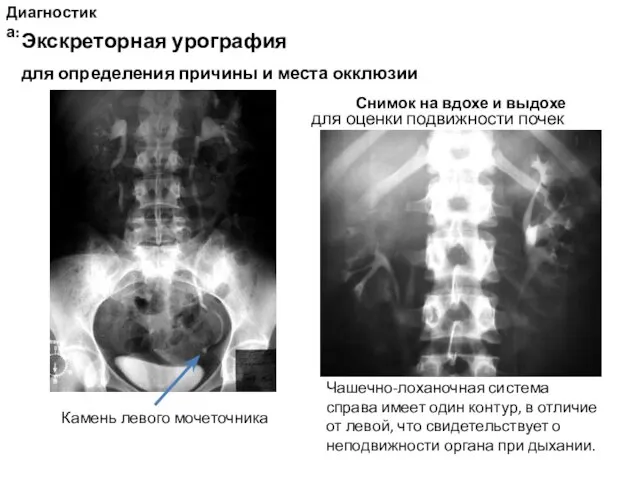 Диагностика: Экскреторная урография для определения причины и места окклюзии Снимок на вдохе