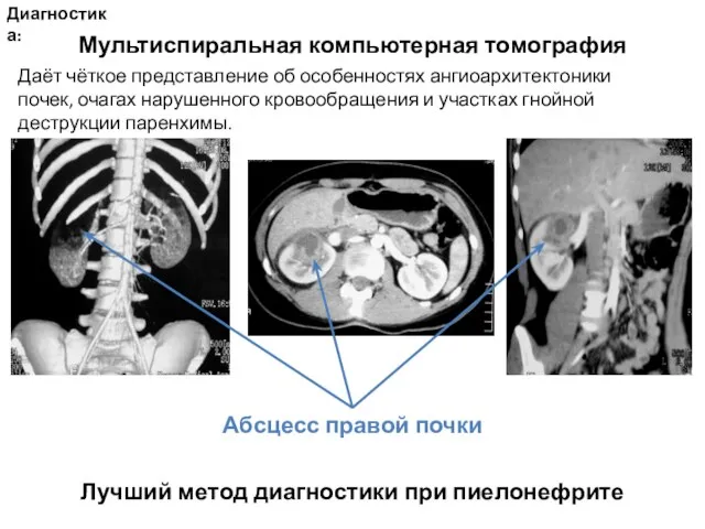 Диагностика: Лучший метод диагностики при пиелонефрите Мультиспиральная компьютерная томография Даёт чёткое представление