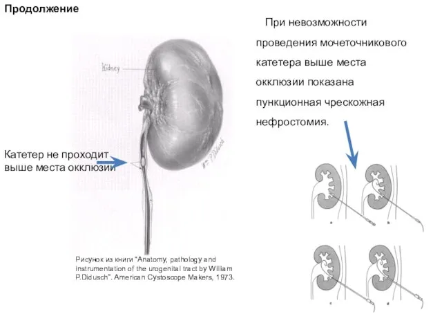 Продолжение Катетер не проходит выше места окклюзии При невозможности проведения мочеточникового катетера