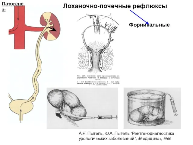 Патогенез: Лоханочно-почечные рефлюксы Форникальные А.Я. Пытель, Ю.А. Пытель “Рентгенодиагностика урологических заболеваний”, «Медицина», 1966