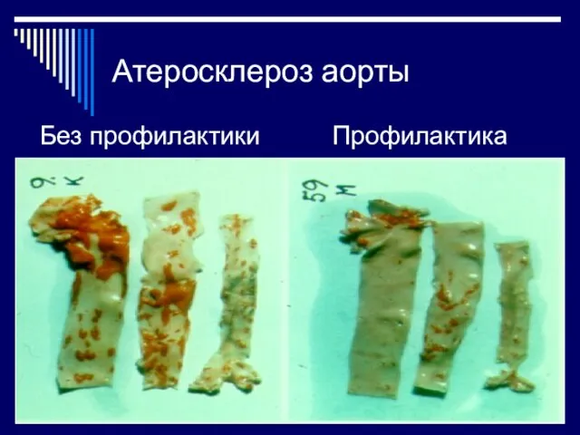 Атеросклероз аорты Без профилактики Профилактика