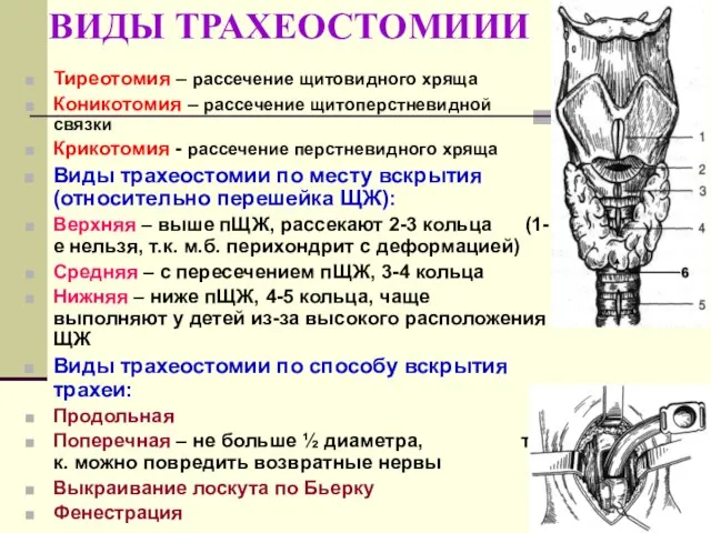 ВИДЫ ТРАХЕОСТОМИИИ Тиреотомия – рассечение щитовидного хряща Коникотомия – рассечение щитоперстневидной связки