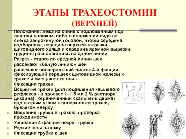 ЭТАПЫ ТРАХЕОСТОМИИ (ВЕРХНЕЙ) Положение: лежа на спине с подложенным под лопатки валиком,