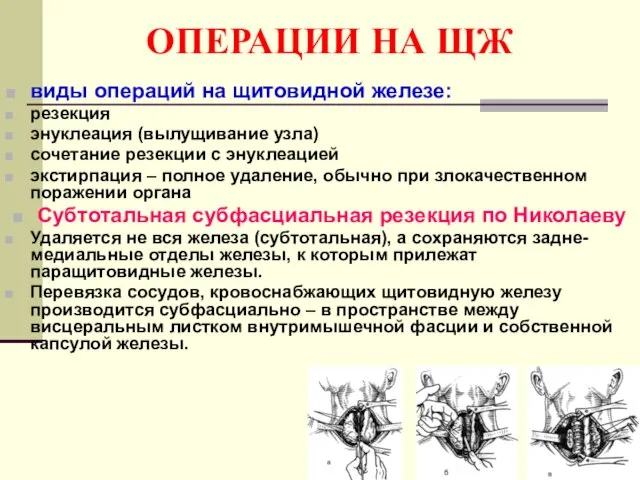 ОПЕРАЦИИ НА ЩЖ виды операций на щитовидной железе: резекция энуклеация (вылущивание узла)