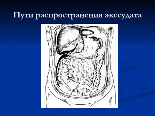 Пути распространения экссудата