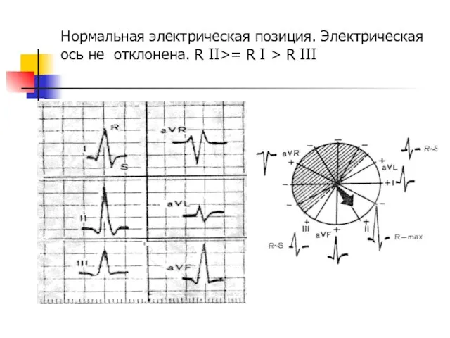 Нормальная электрическая позиция. Электрическая ось не отклонена. R ІІ>= R І > R ІІІ