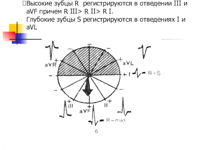 Высокие зубцы R регистрируются в отведении ІІІ и аVF причем R ІІІ>