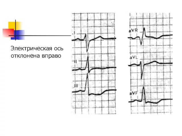Электрическая ось отклонена вправо