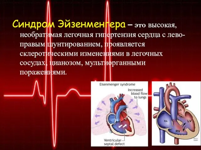 Синдром Эйзенменгера – это высокая, необратимая легочная гипертензия сердца с лево-правым шунтированием,