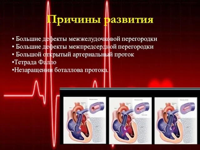 Причины развития • Большие дефекты межжелудочковой перегородки • Большие дефекты межпредсердной перегородки