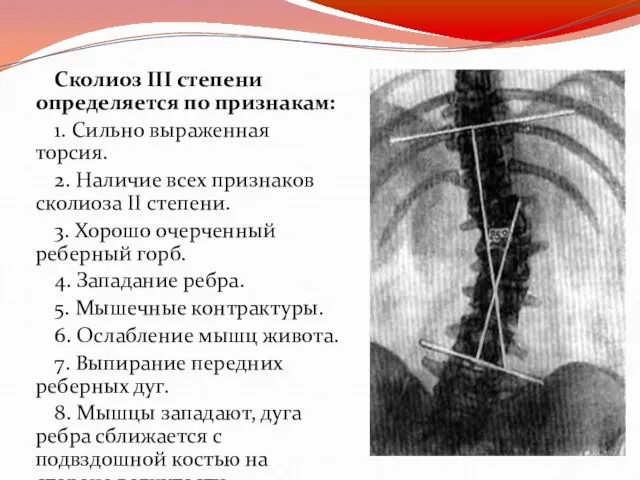 Сколиоз III степени определяется по признакам: 1. Сильно выраженная торсия. 2. Наличие