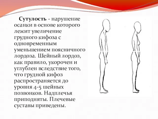 Сутулость - нарушение осанки в основе которого лежит увеличение грудного кифоза с