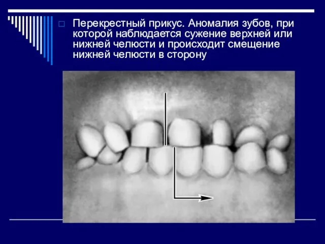 Перекрестный прикус. Аномалия зубов, при которой наблюдается сужение верхней или нижней челюсти