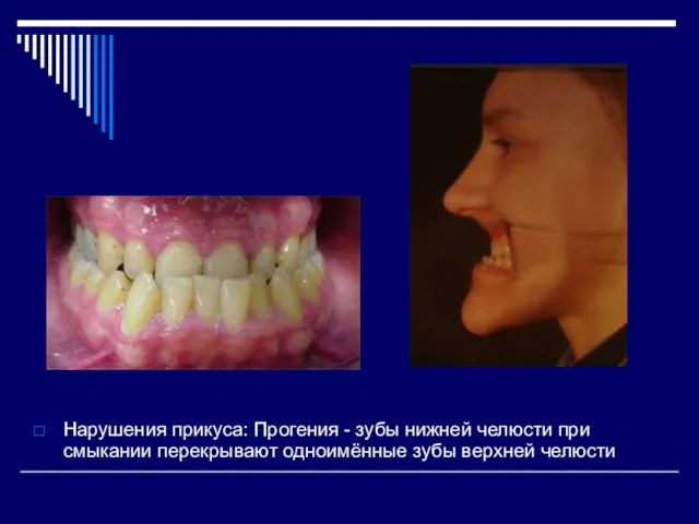 Нарушения прикуса: Прогения - зубы нижней челюсти при смыкании перекрывают одноимённые зубы верхней челюсти