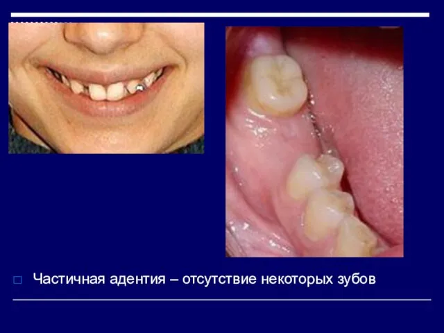 Частичная адентия – отсутствие некоторых зубов
