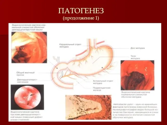 ПАТОГЕНЕЗ (продолжение 1)