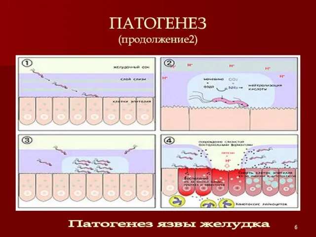 ПАТОГЕНЕЗ (продолжение2) Патогенез язвы желудка