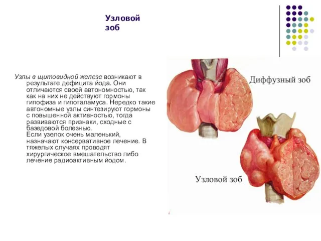 Узлы в щитовидной железе возникают в результате дефицита йода. Они отличаются своей