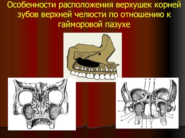 Особенности расположения верхушек корней зубов верхней челюсти по отношению к гайморовой пазухе