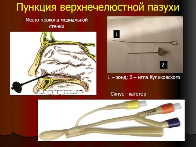 Пункция верхнечелюстной пазухи Место прокола медиальной стенки Синус - катетер 1 2