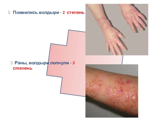 Появились волдыри - 2 степень Раны, волдыри лопнули - 3 степень