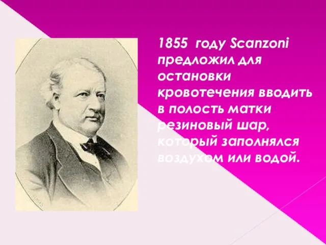 1855 году Scanzoni предложил для остановки кровотечения вводить в полость матки резиновый