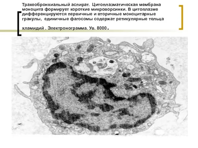 Трахеобронхиальный аспират. Цитоплазматическая мембрана моноцита формирует короткие микроворсинки. В цитоплазме дифференцируются первичные