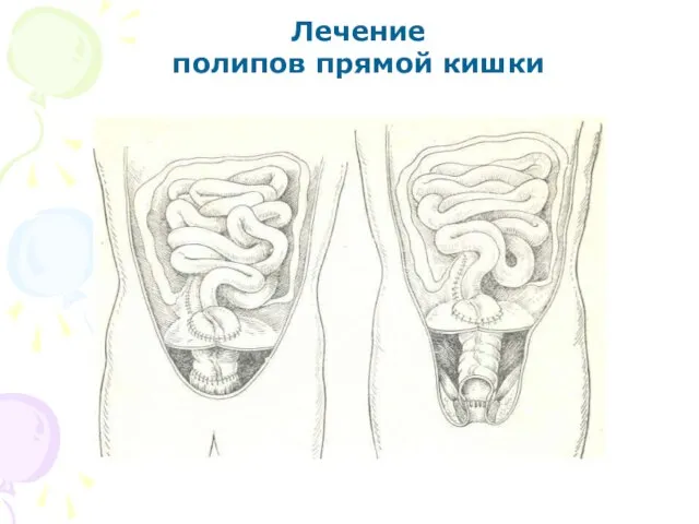 Лечение полипов прямой кишки