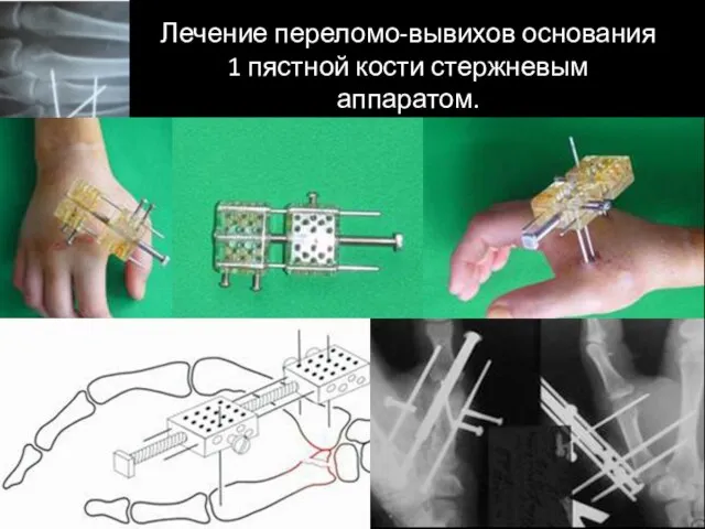 Лечение переломо-вывихов основания 1 пястной кости стержневым аппаратом.