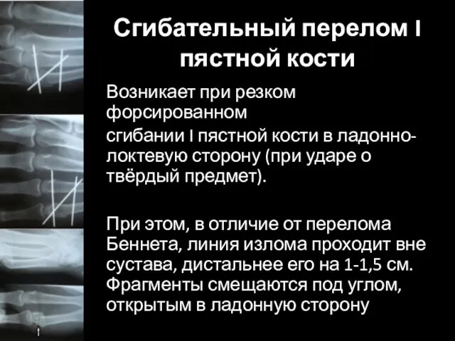 Сгибательный перелом I пястной кости Возникает при резком форсированном сгибании I пястной