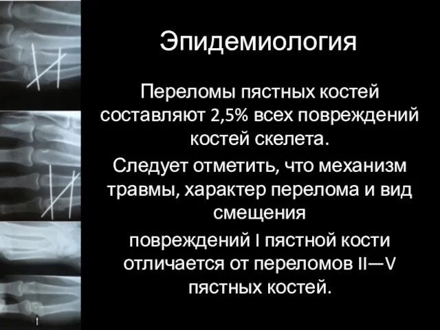 Эпидемиология Переломы пястных костей составляют 2,5% всех повреждений костей скелета. Следует отметить,