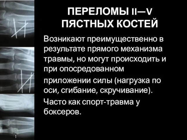 ПЕРЕЛОМЫ II—V ПЯСТНЫХ КОСТЕЙ Возникают преимущественно в результате прямого механизма травмы, но