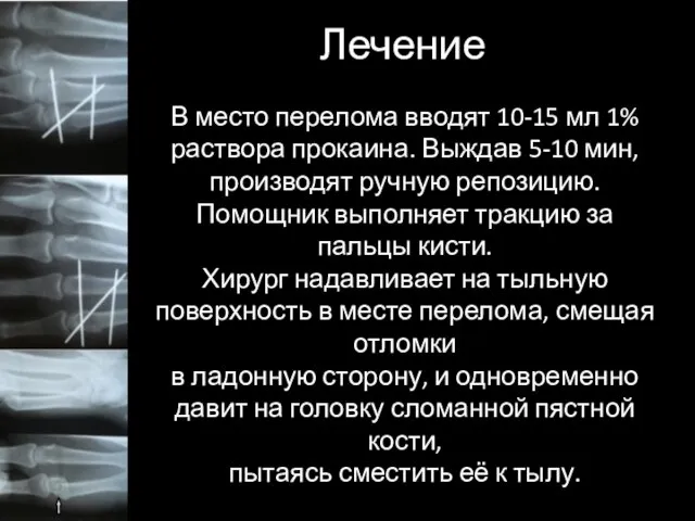 Лечение В место перелома вводят 10-15 мл 1% раствора прокаина. Выждав 5-10