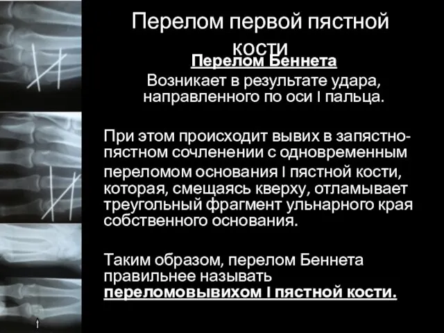 Перелом первой пястной кости Перелом Беннета Возникает в результате удара, направленного по