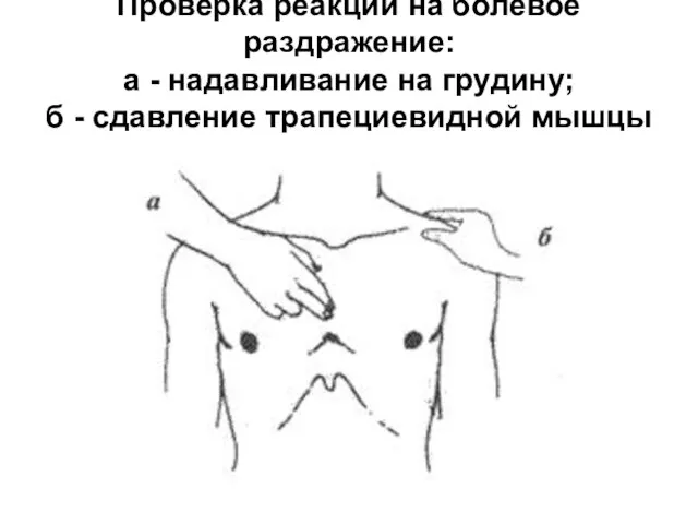 Проверка реакции на болевое раздражение: а - надавливание на грудину; б - сдавление трапециевидной мышцы