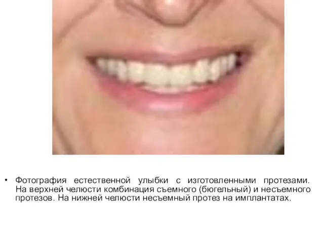 Фотография естественной улыбки с изготовленными протезами. На верхней челюсти комбинация съемного (бюгельный)