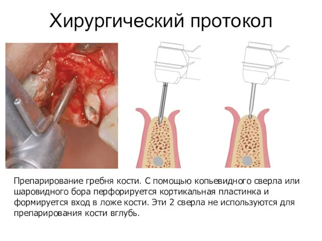 Хирургический протокол Препарирование гребня кости. С помощью копьевидного сверла или шаровидного бора