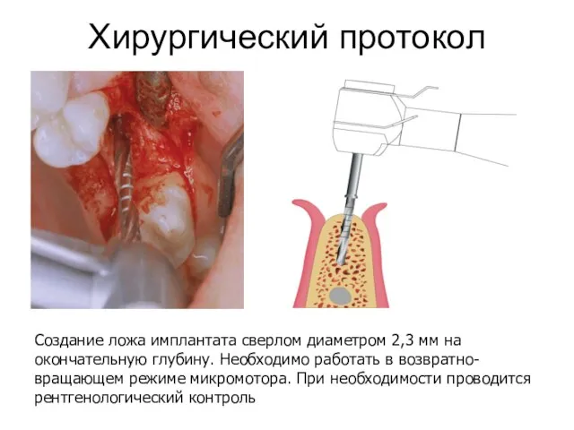 Хирургический протокол Создание ложа имплантата сверлом диаметром 2,3 мм на окончательную глубину.