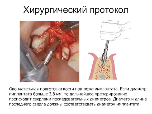 Хирургический протокол Окончательная подготовка кости под ложе имплантата. Если диаметр имплантата больше