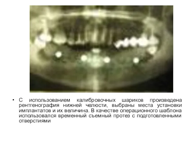 С использованием калибровочных шариков произведена рентгенография нижней челюсти, выбраны места установки имплантатов