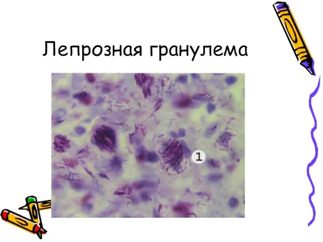 Лепрозная гранулема