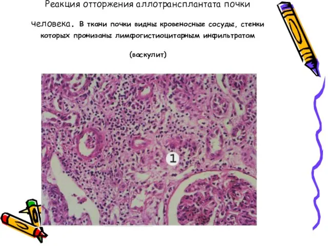 Реакция отторжения аллотрансплантата почки человека. В ткани почки видны кровеносные сосуды, стенки