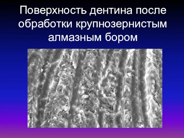 Поверхность дентина после обработки крупнозернистым алмазным бором