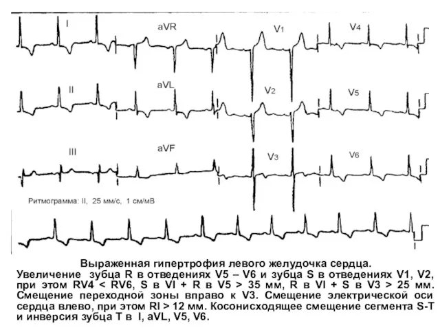 Выраженная гипертрофия левого желудочка сердца. Увеличение зубца R в отведениях V5 –